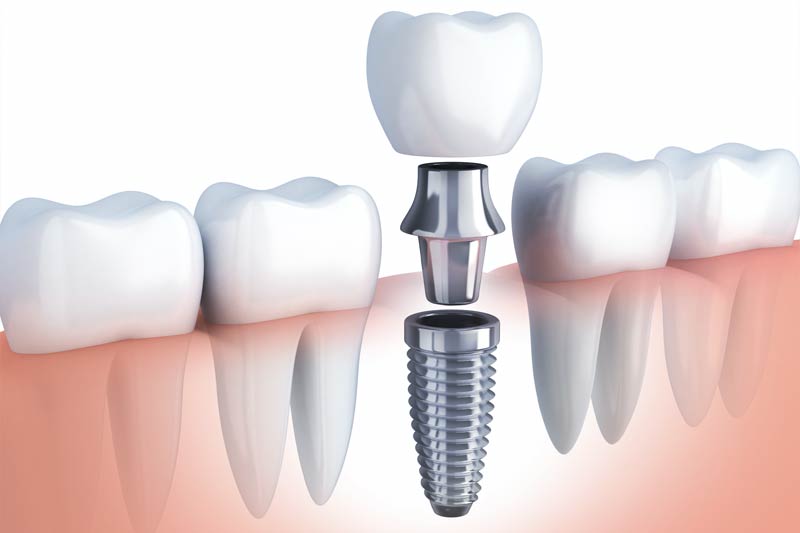Implants Dentist in Chicago