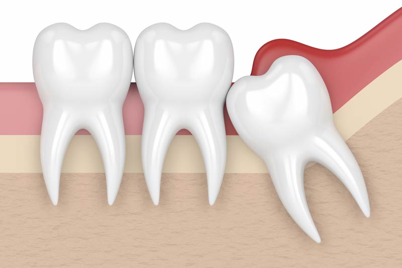 Wisdom Tooth Removal in Chicago